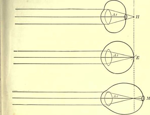 Рис. 4. Схема глазных яблок с гиперметропией, эмметропией (норма) и миопией. H — гиперметропия; E — эмметропия; M — миопия; Ax — оптическая ось. Обратите внимание, что при гиперметропии и миопии лучи, вместо того чтобы попадать в фокус, образуют круглое пятно на сетчатке.